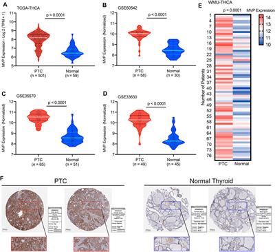 Major Vault Protein (MVP) Associated With BRAFV600E Mutation Is an Immune Microenvironment-Related Biomarker Promoting the Progression of Papillary Thyroid Cancer via MAPK/ERK and PI3K/AKT Pathways